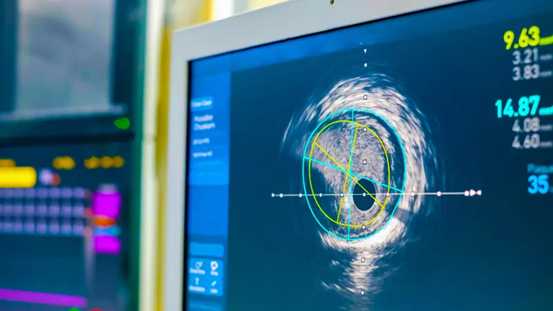 Intravascular ultrasound imaging screen in a lab room.